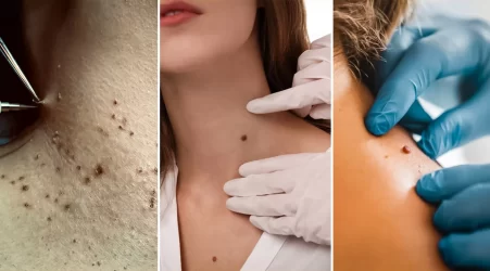 Safe Ways to Remove Skin Tags